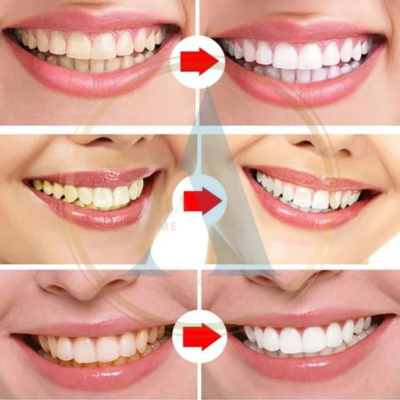 Lápiz Blanqueador Dientes Instantáneo™